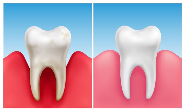 Gingivita simptome inflamare gingie